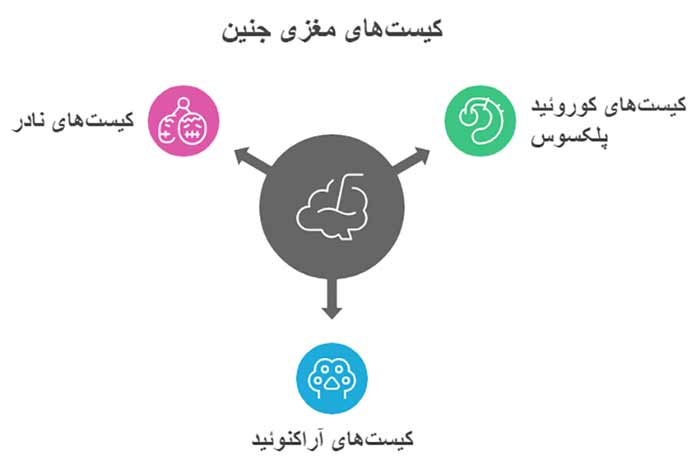 اینفوگرافیک کیست‌های مغز جنین