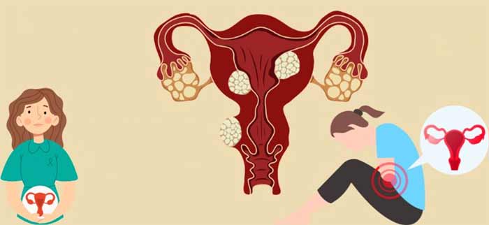 بیماری زنان فیبروم رحمی