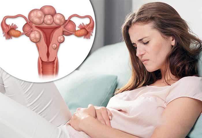 بیماری زنان بیماری زنان فیبروم