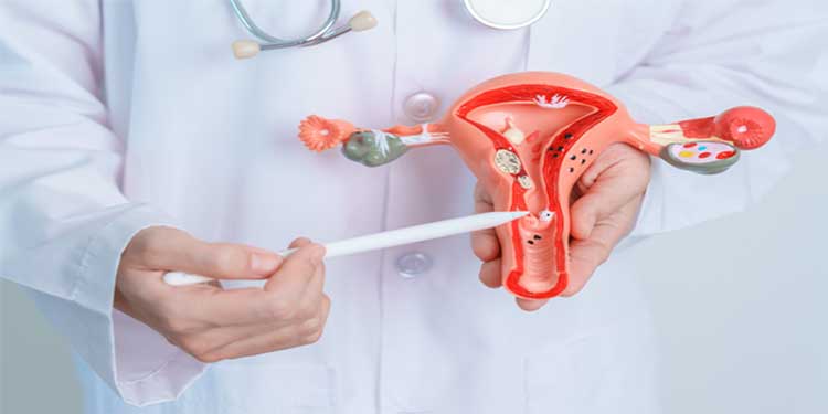 فیبروم رحم (Uterine Fibroids): شایع‌ترین توده‌های خوش‌خیم