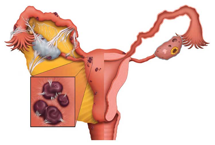 اندومتریوز (Endometriosis): معمای درد مزمن و تأخیر در تشخیص