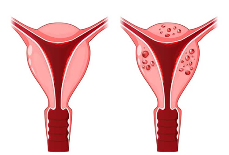 آدنومیوز (Adenomyosis): رحم بزرگ و دردناک