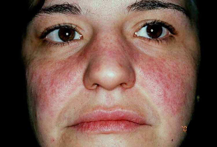 لوپوس (Lupus): بیماری هزار چهره