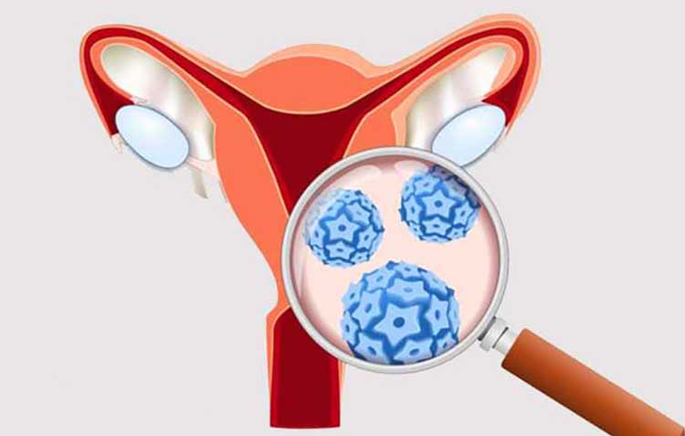 سرطان دهانه رحم: تنها سرطان قابل پیشگیری با واکسن