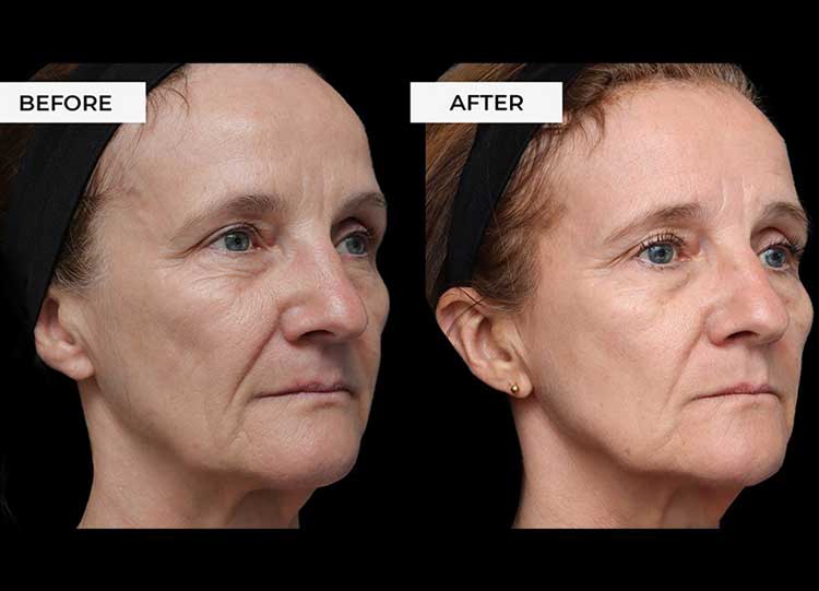 بخش سوم: آر-اف میکرونیدلینگ (RF Microneedling)؛ سفت‌کننده و بافت‌ساز