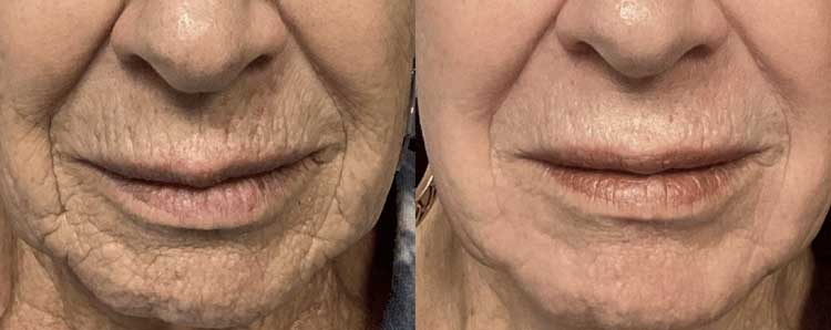 بخش چهارم: لیزر کورینگ (Laser Coring)؛ بازسازی عمیق با دقت بالا